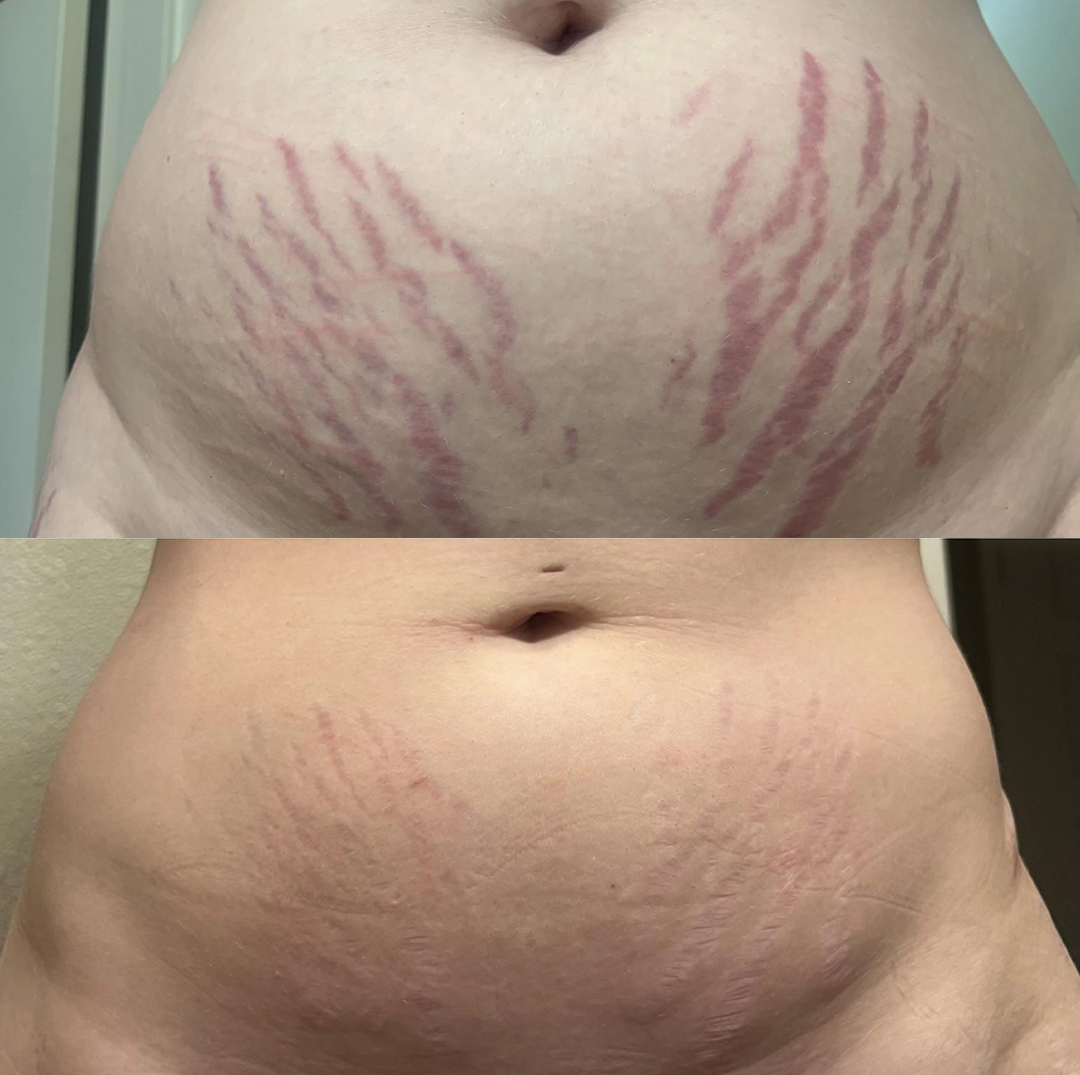 🔥Last Day Discount🔥 Coredew® DERMALUX Texture Repair Gel