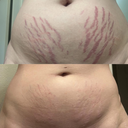 🔥Last Day Discount🔥 Coredew® DERMALUX Texture Repair Gel